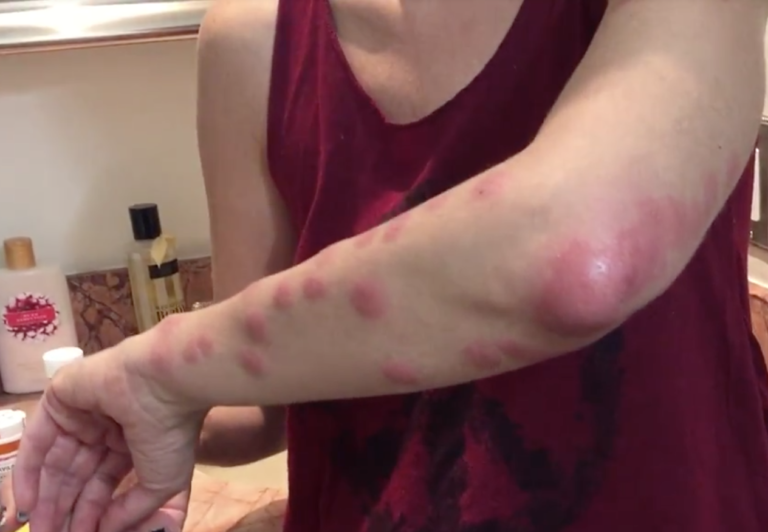 Graphic Images:  Apparent Bed Bug Attack At High-End Resort